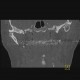 Arthrosis of temporomandibular joint, osteoarthritis: CT - Computed tomography